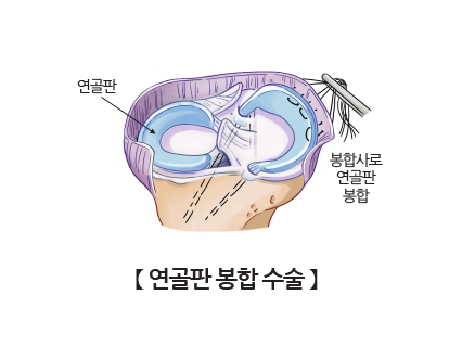 연골판 봉합 수술