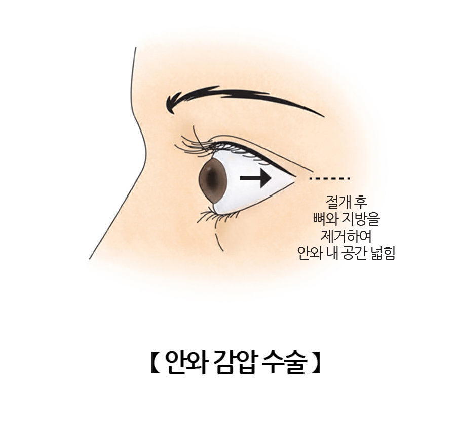 안와감압술