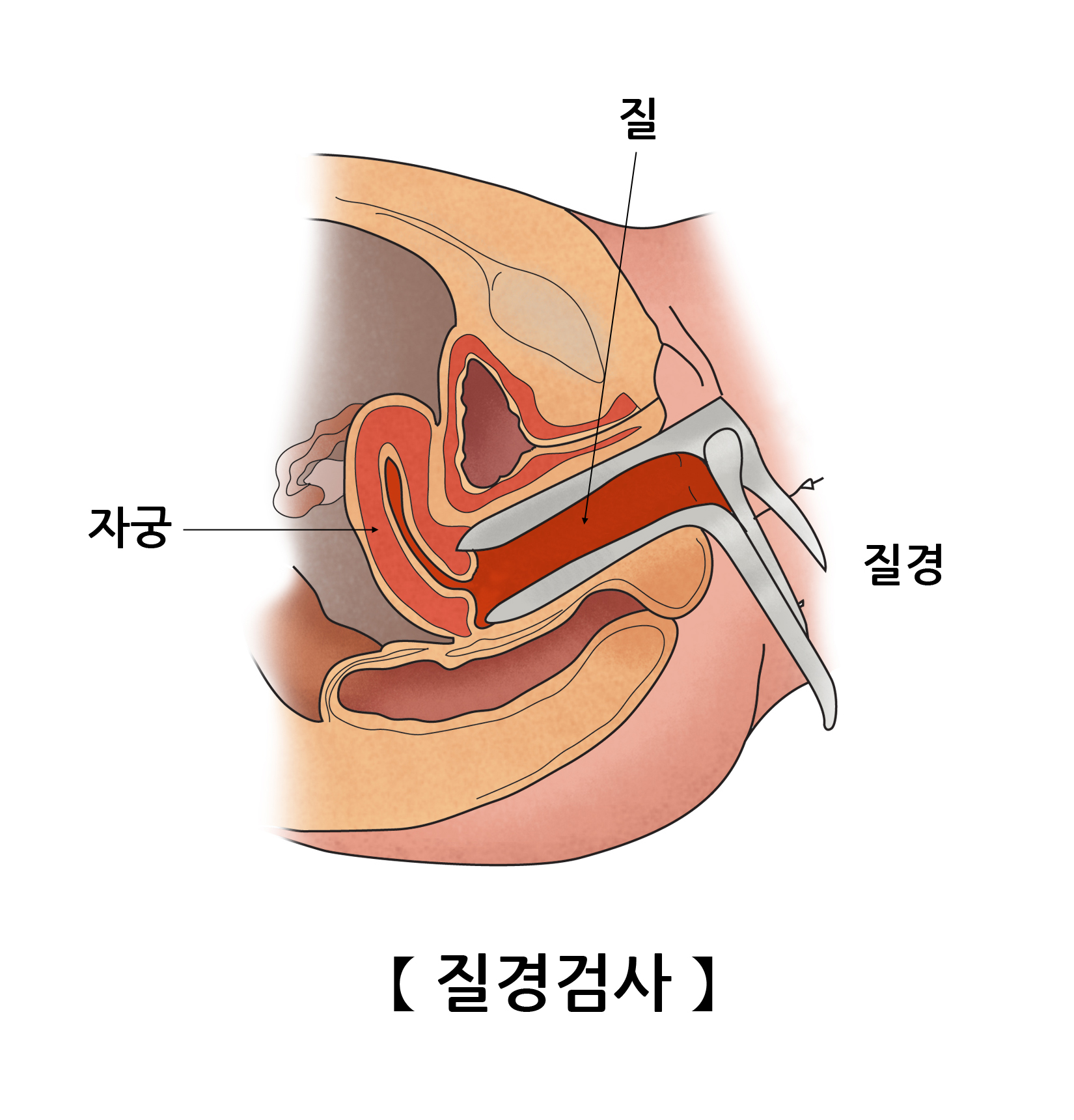 질경검사법