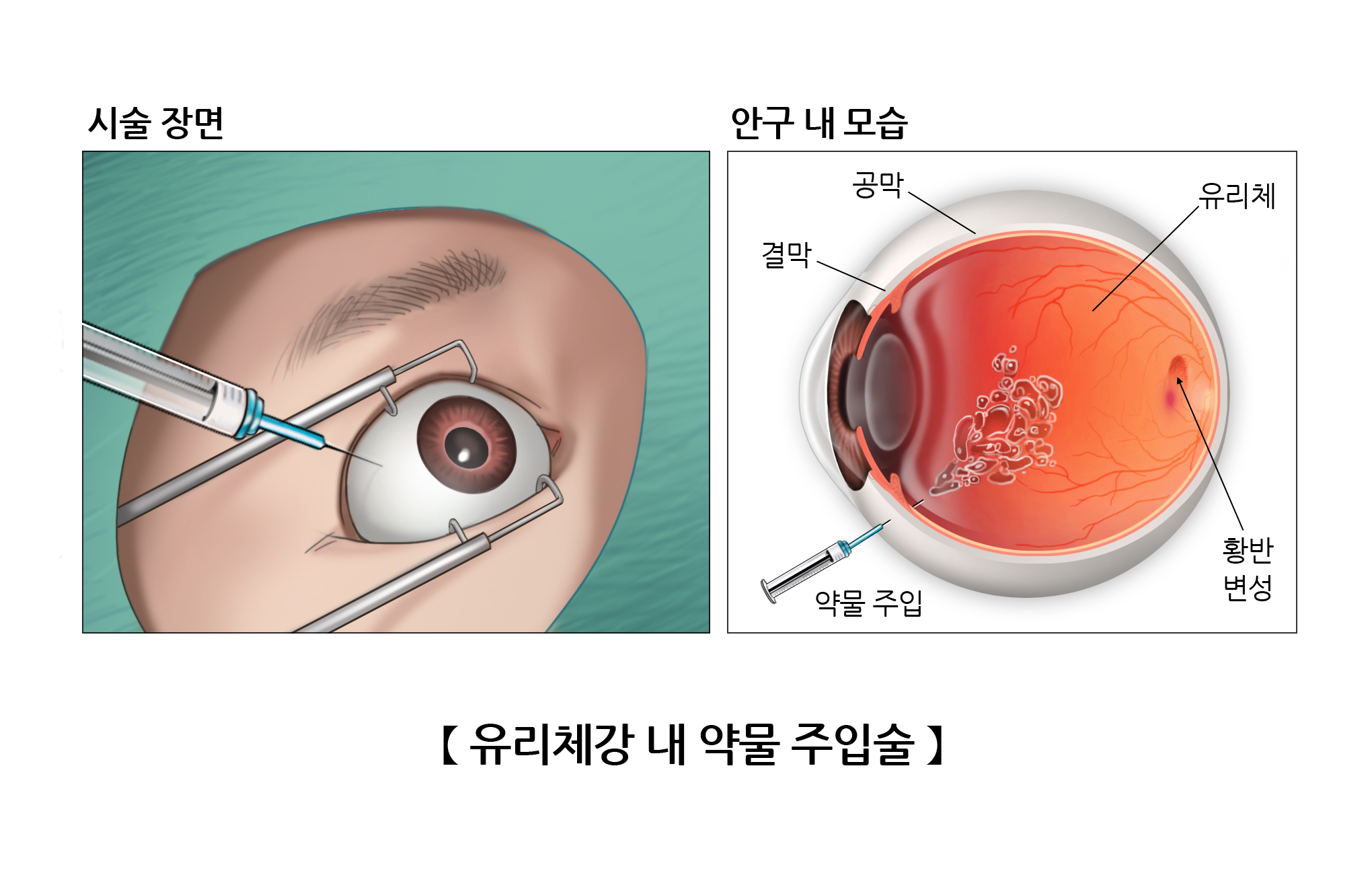 유리체강 내 약물 주입술
