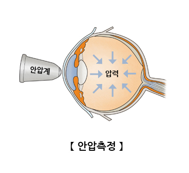 안압측정