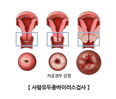 사람유두종바이러스검사