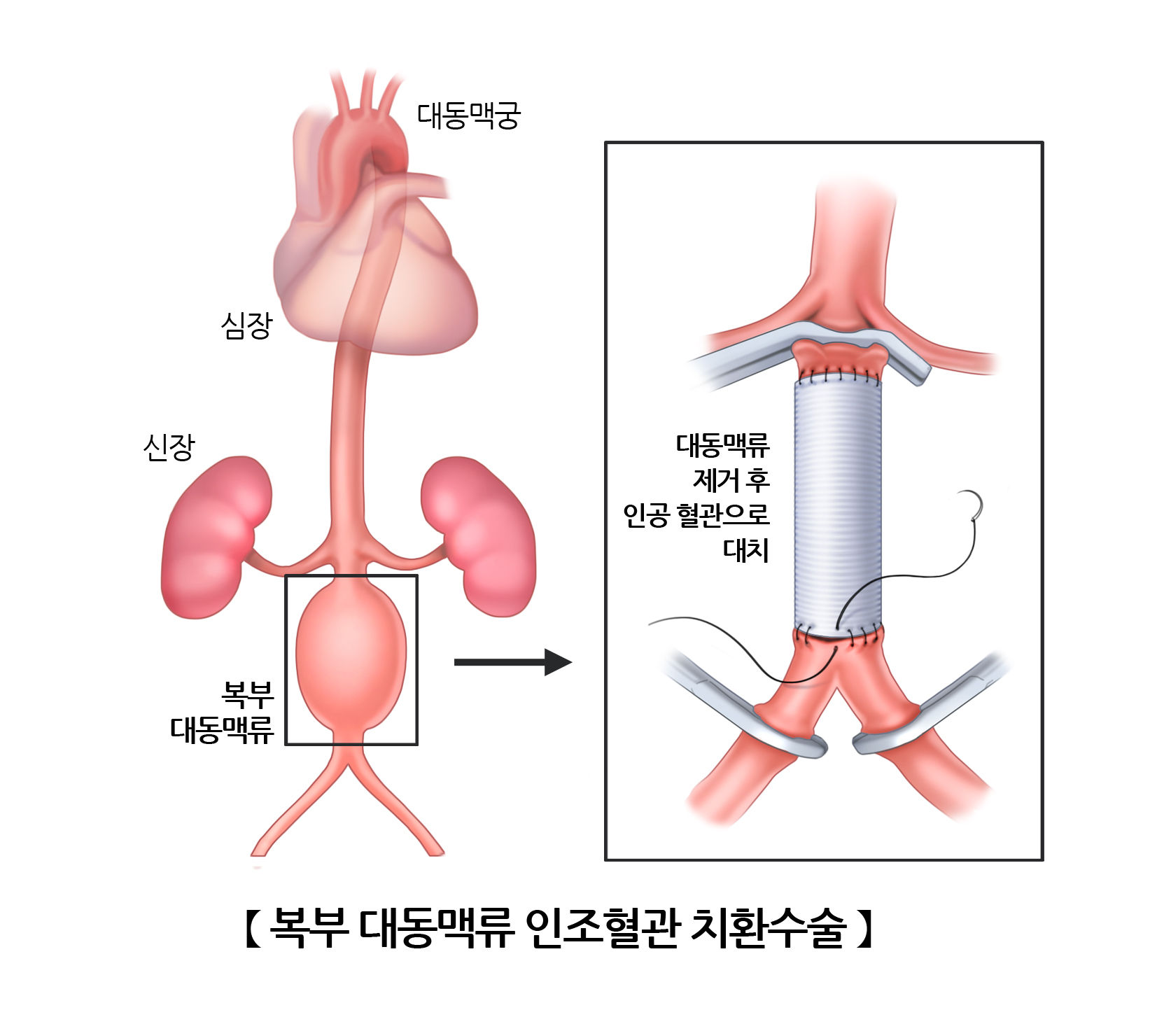 복부 대동맥류 인조 혈관 치환 수술