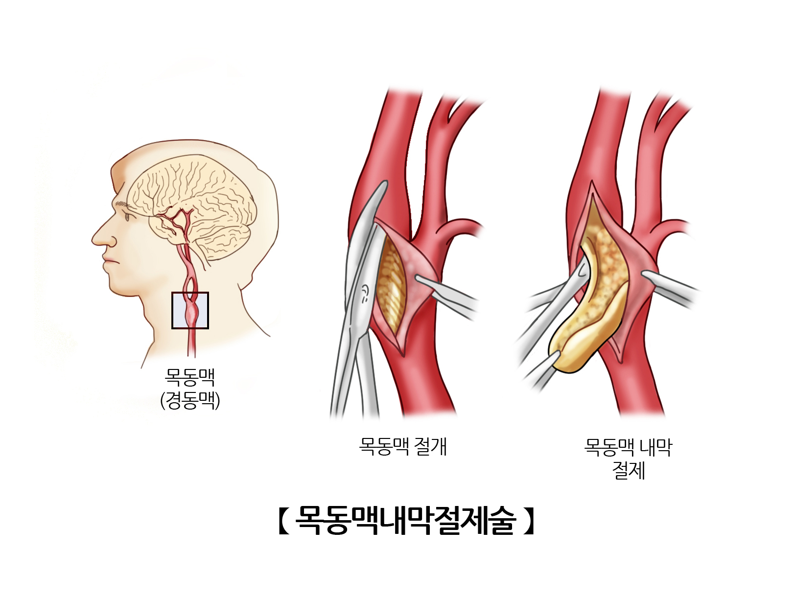 목동맥내막절제술