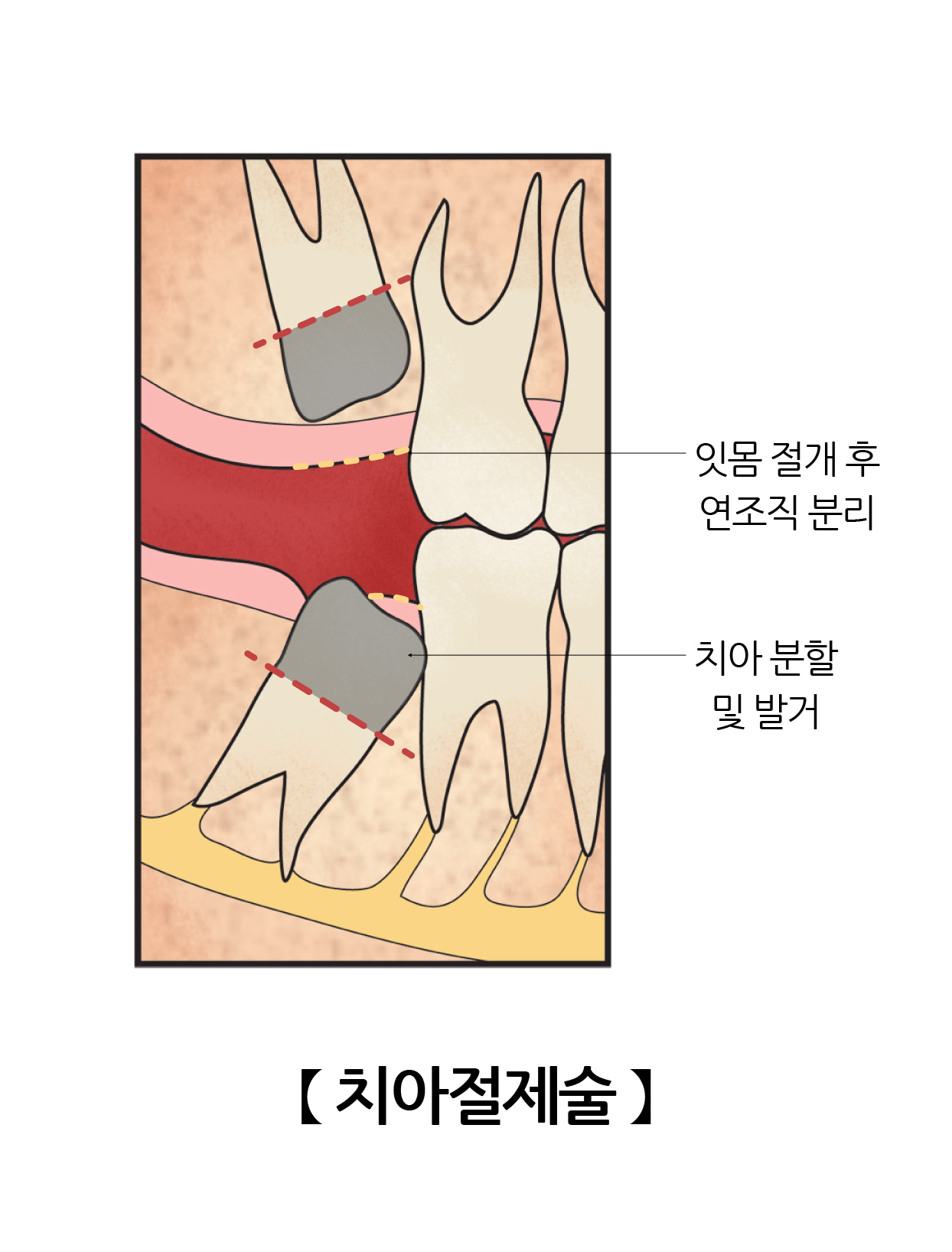 치아절제술