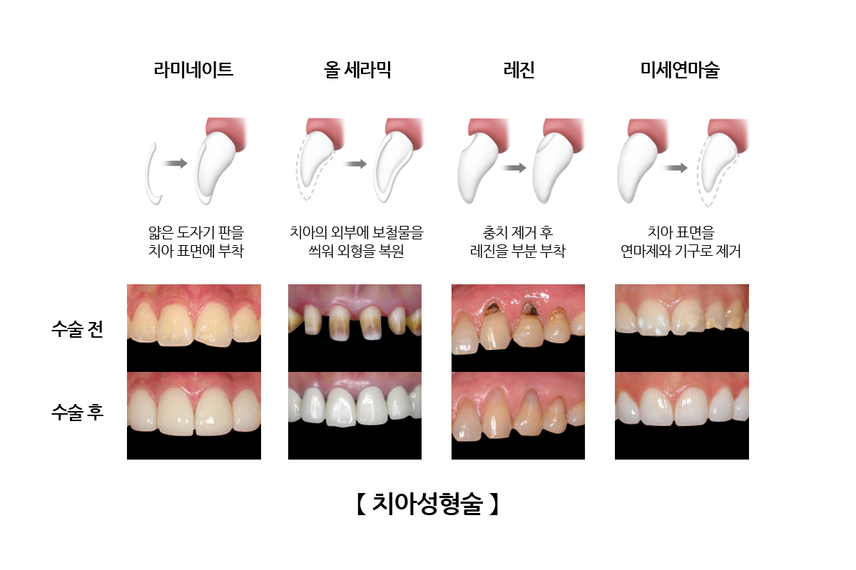 치아성형술