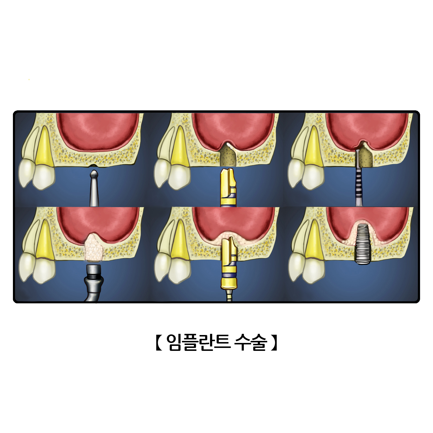 임플란트 수술