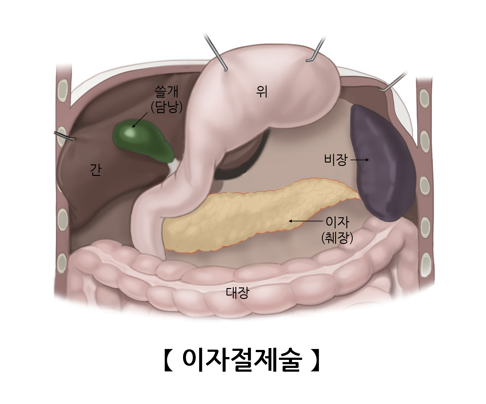 이자절제술