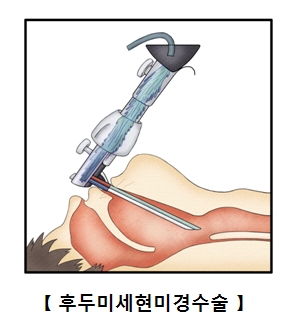 후두미세현미경수술