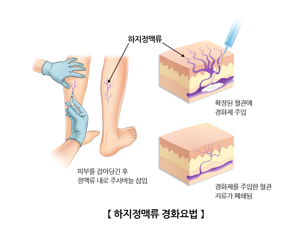하지정맥류 경화요법