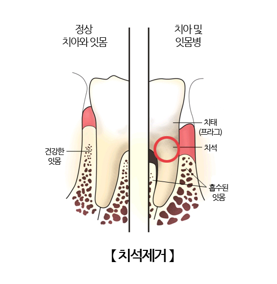 치석제거