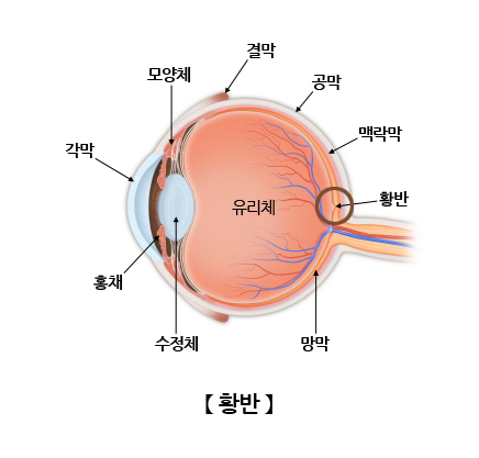 황반