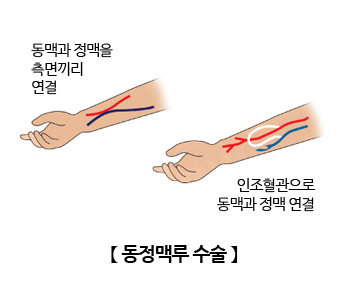 동정맥루 수술