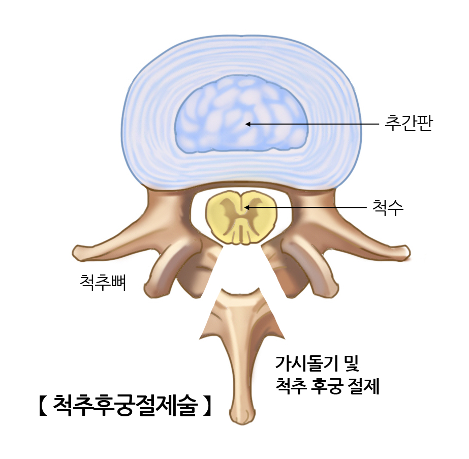 척추후궁절제술