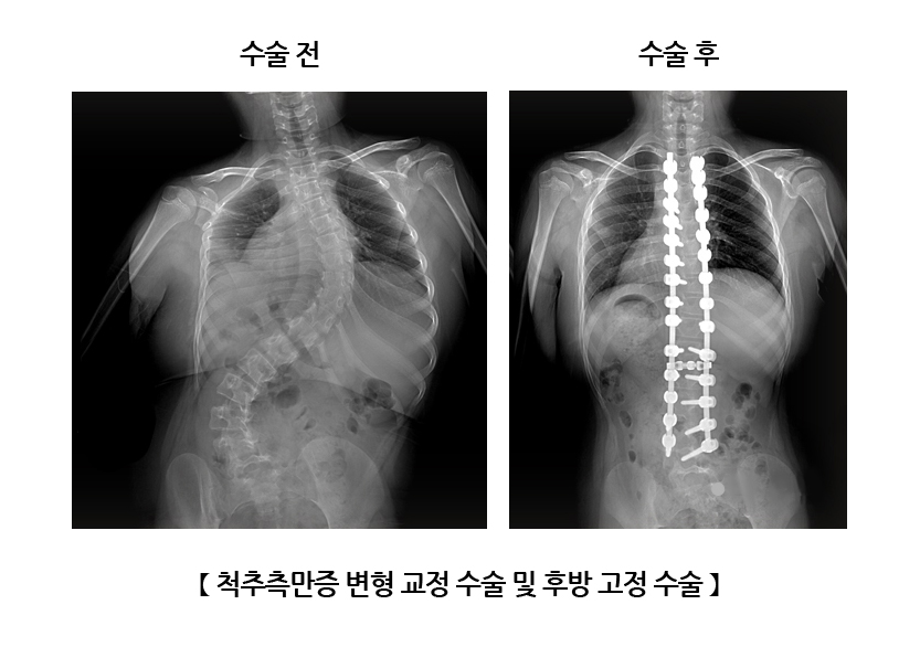 척추측만증 변형 교정 수술 및 후방 고정 수술