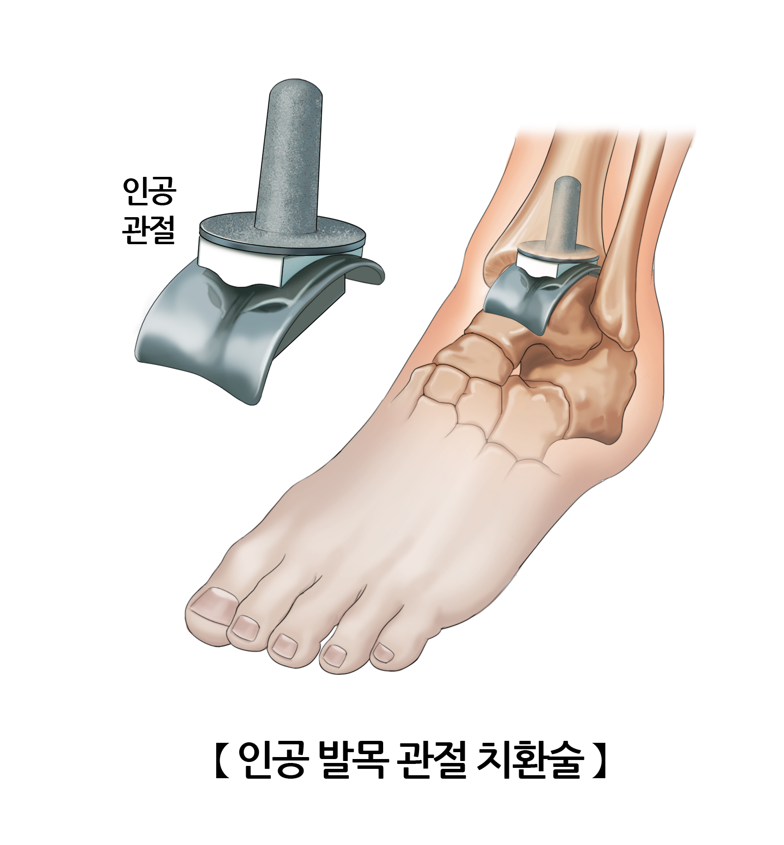인공 발목 관절 치환술