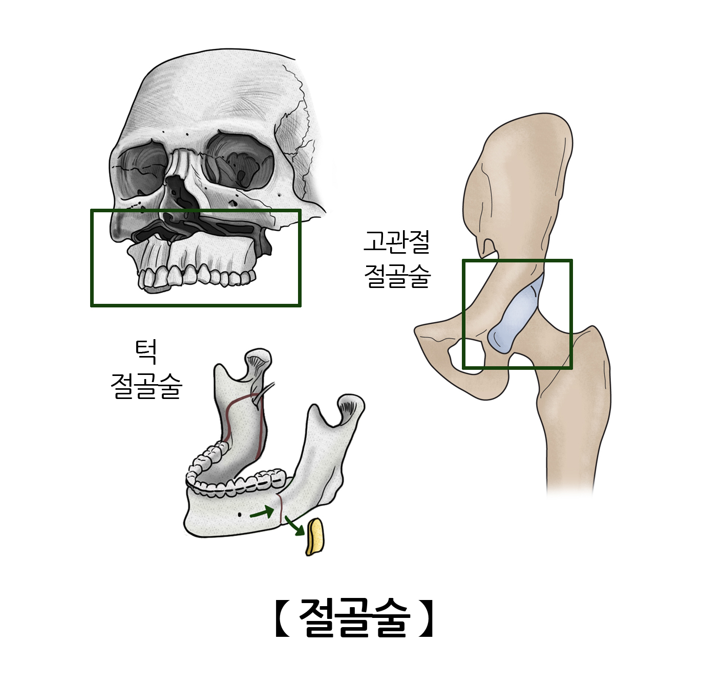 절골술