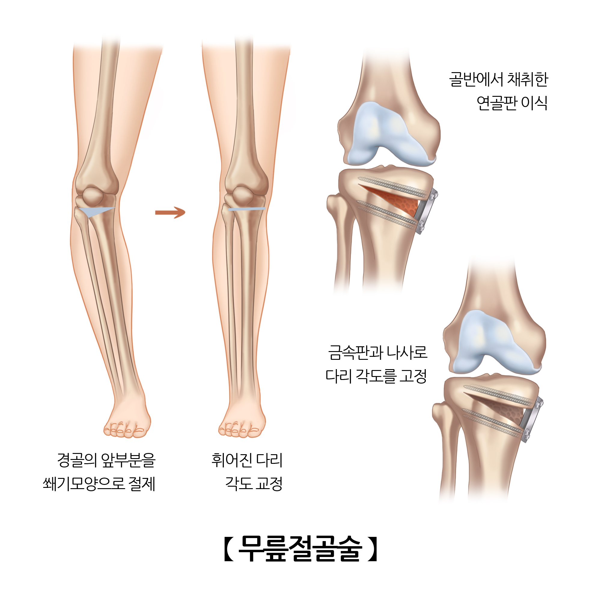 무릎절골술