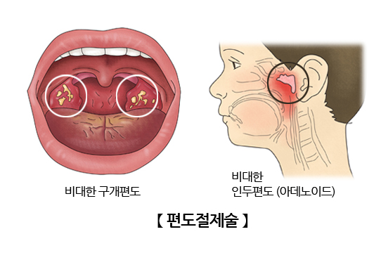 편도절제술