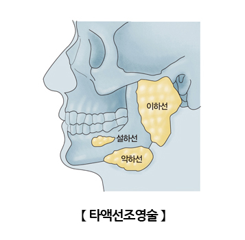 타액선조영술