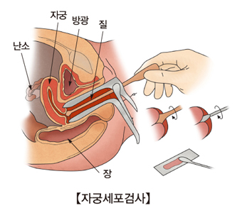 자궁세포검사