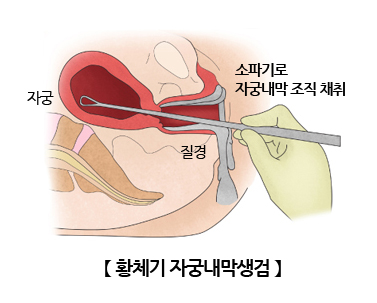 황체기 자궁내막생검