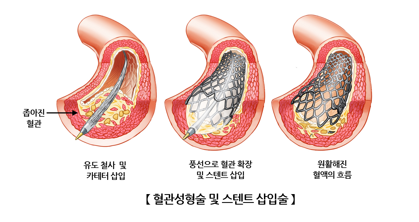 혈관성형술 및 스텐트 삽입술