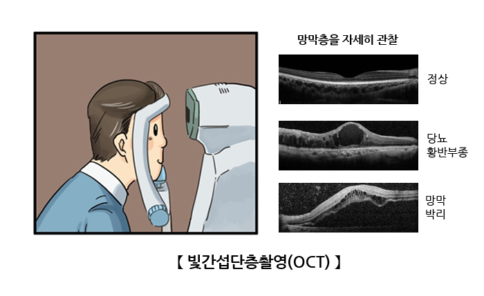 빛간섭단층촬영(OCT)