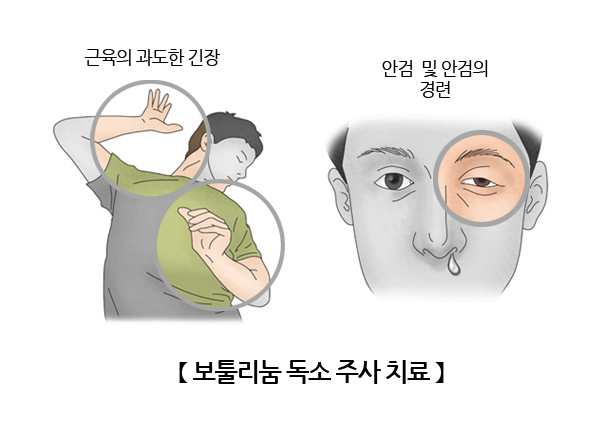 보툴리눔 독소 주사 치료