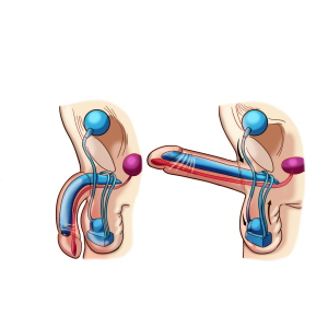 음경 보형물 삽입 수술