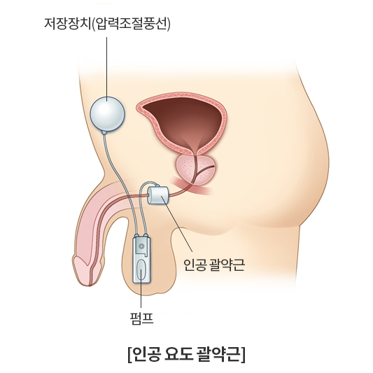 인공 요도 괄약근