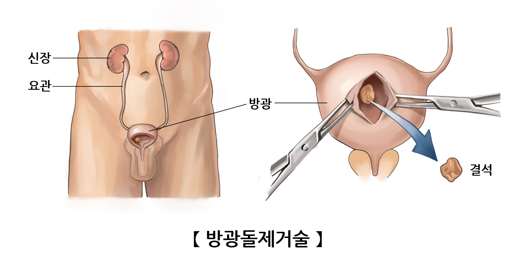 방광돌제거술