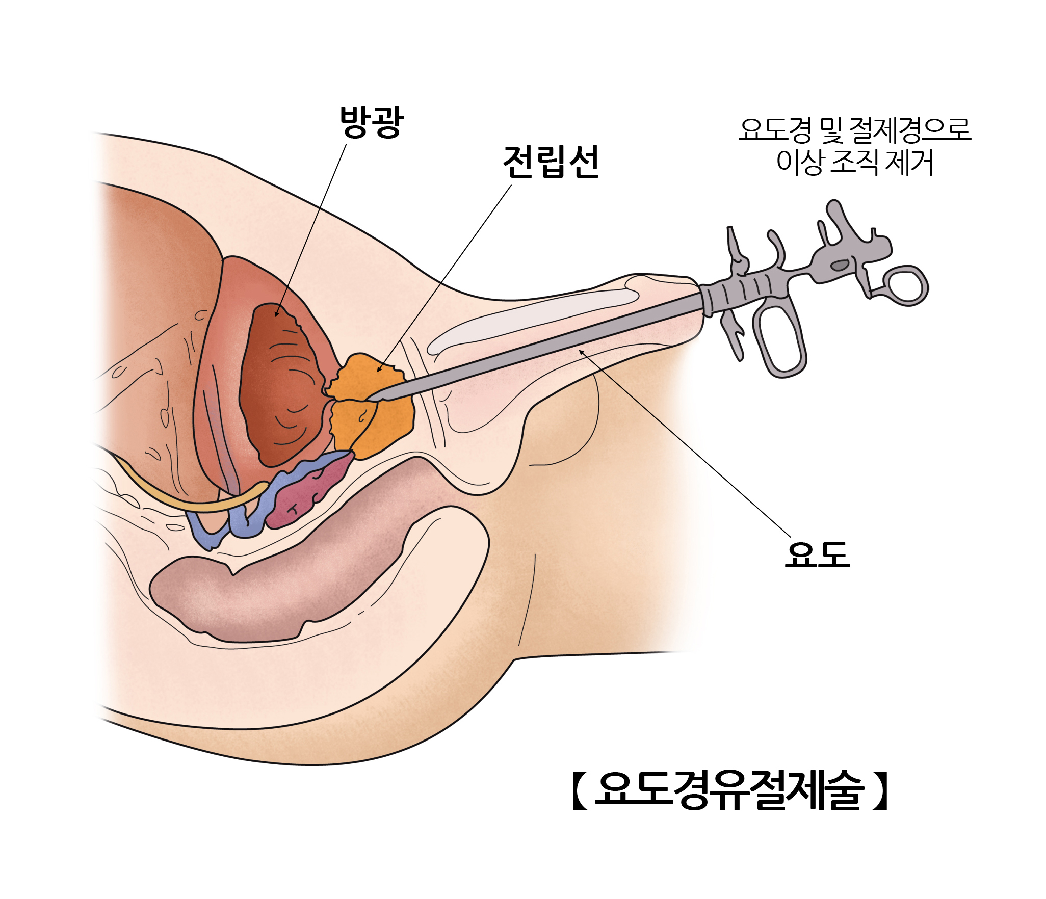 요도경유절제술