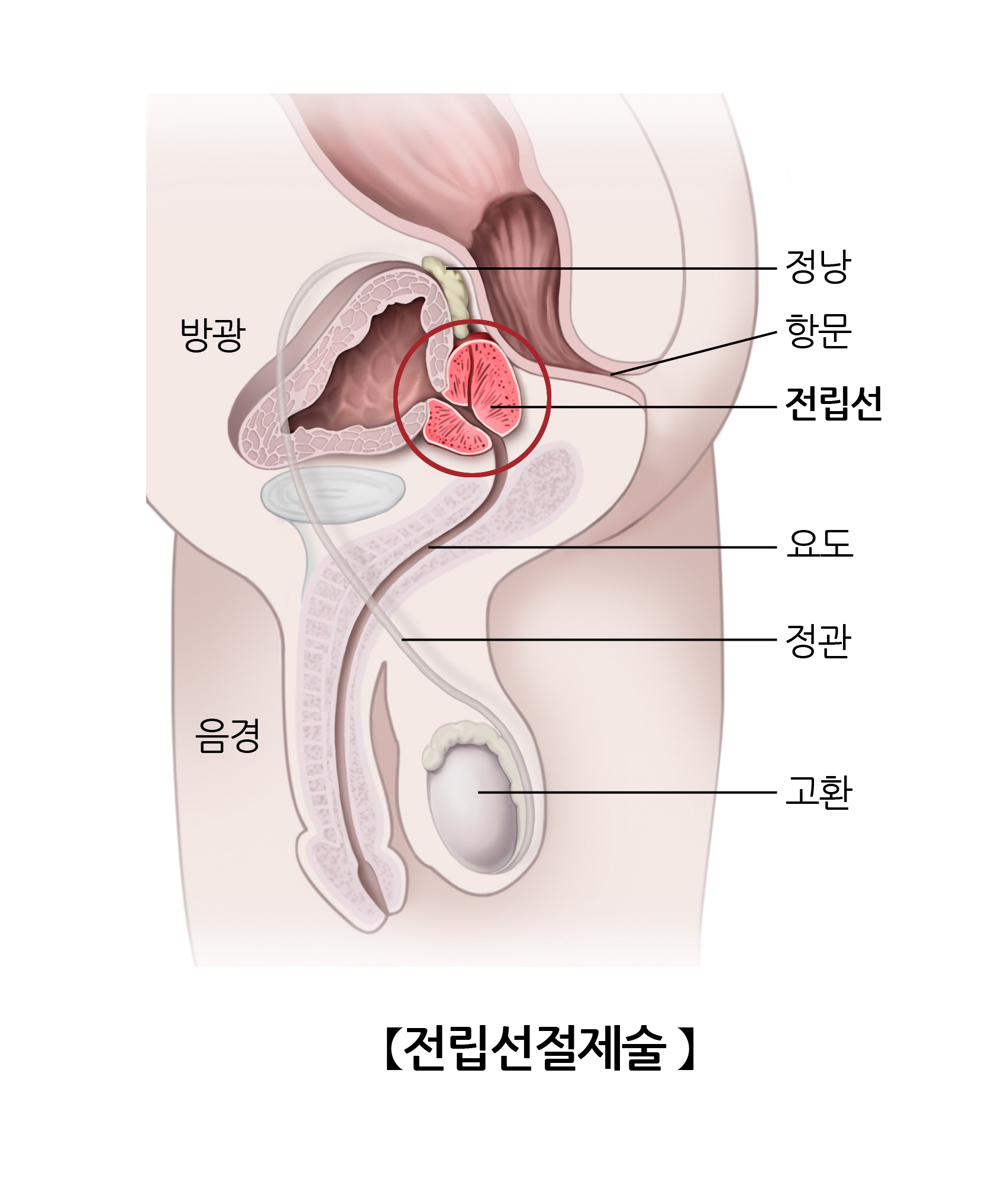 전립선절제술