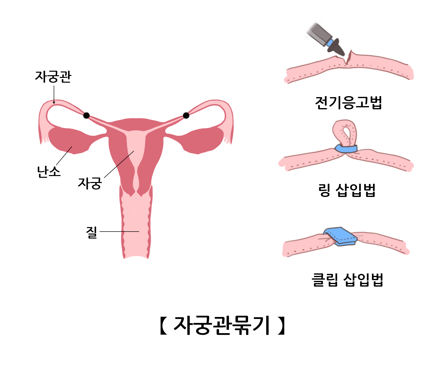 자궁관묶기