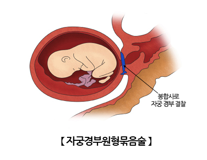자궁경부원형묶음술