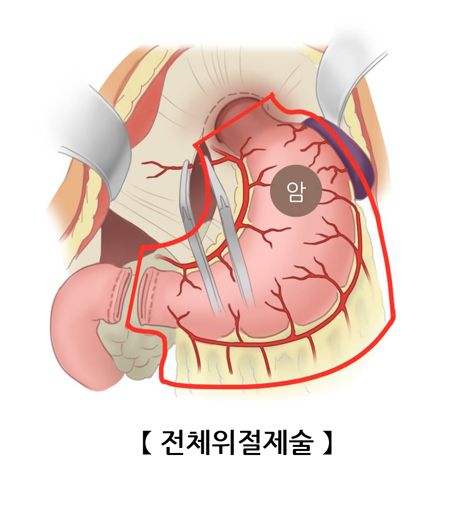 전체위절제술