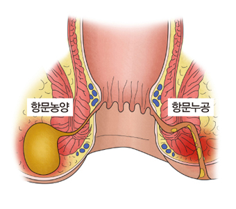 샛길절제술