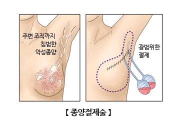 종양절제술