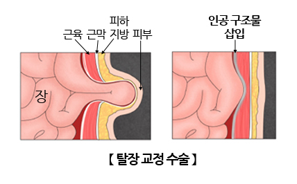 탈장 교정 수술