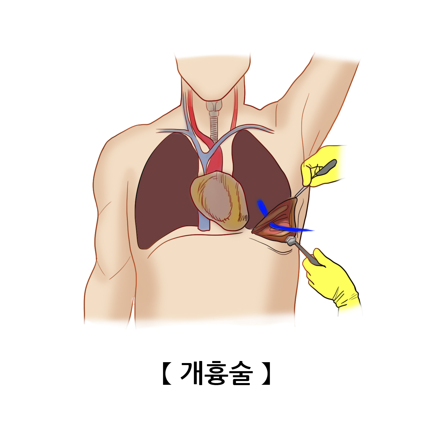 개흉술