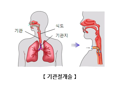 기관절개술