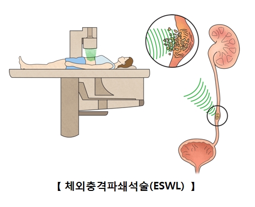 체외충격파쇄석술(ESWL)