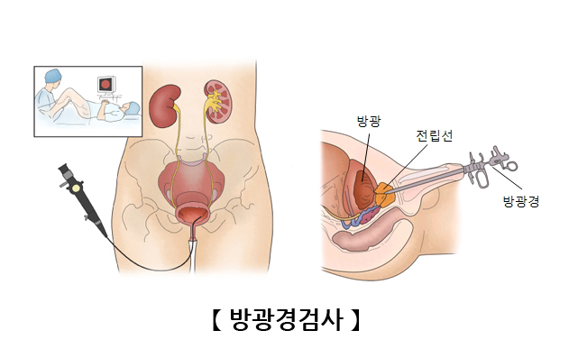 방광경검사