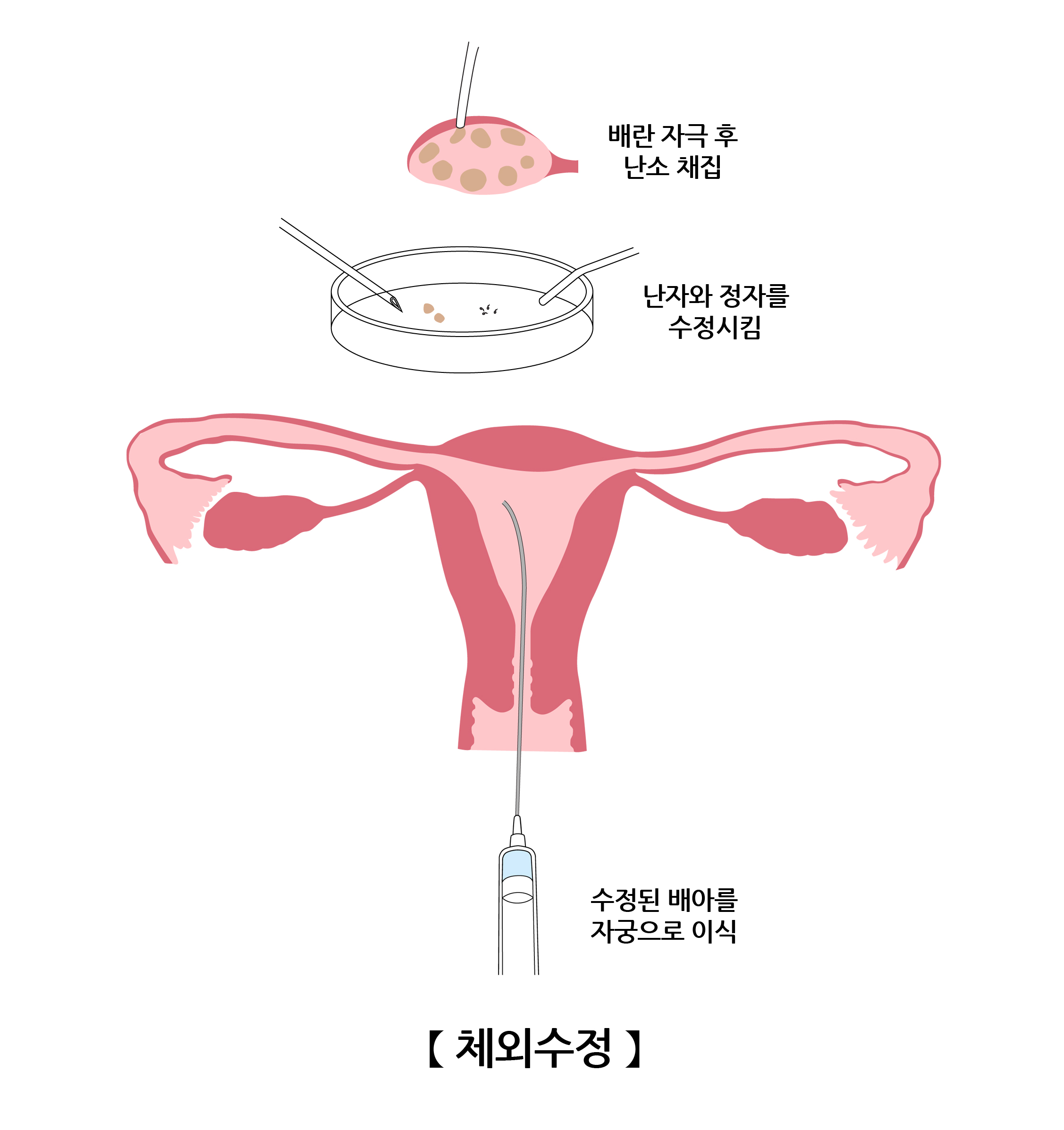체외수정