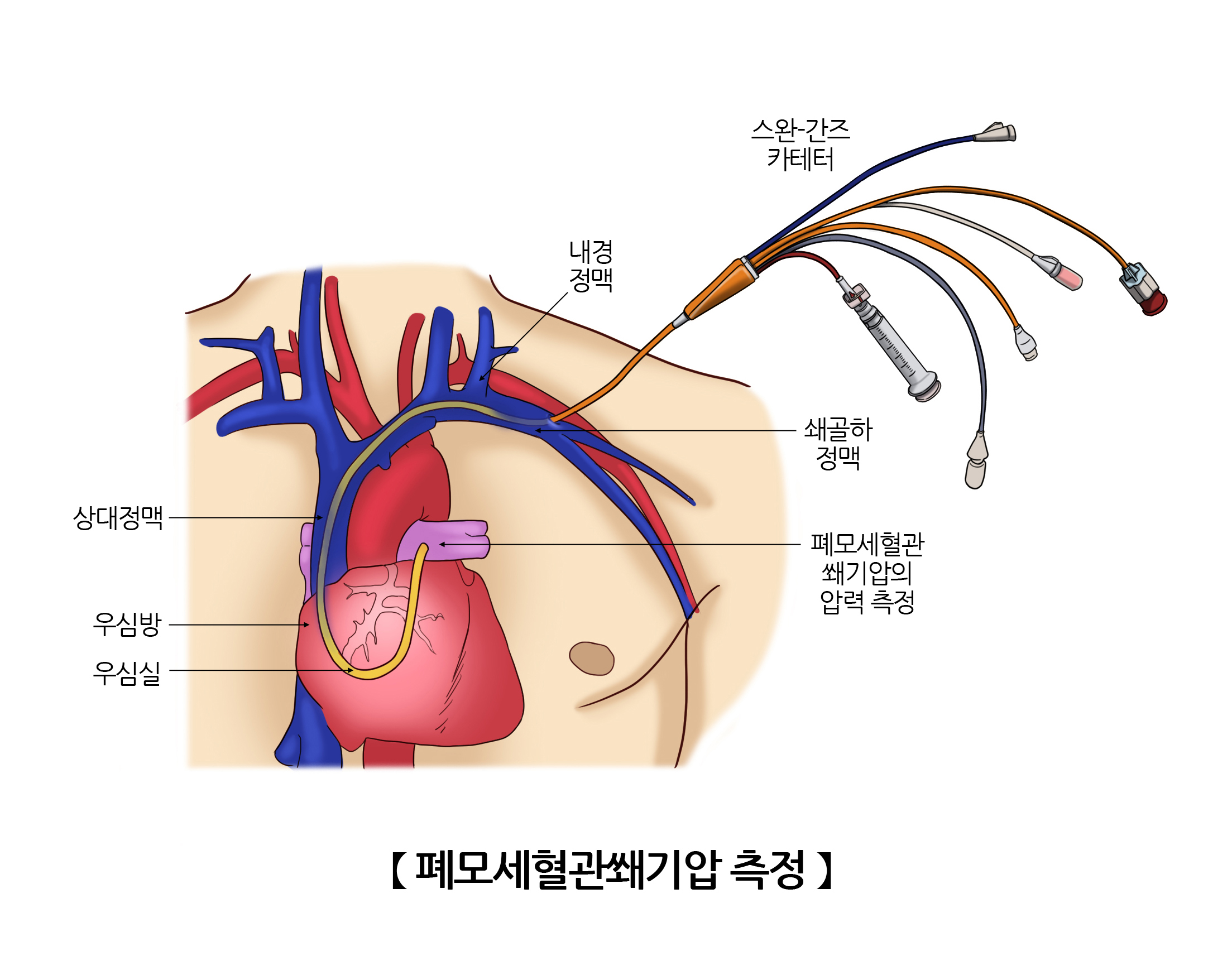 폐모세혈관쐐기압 측정