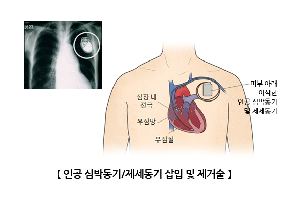 인공 심박동기/제세동기 삽입 및 제거술