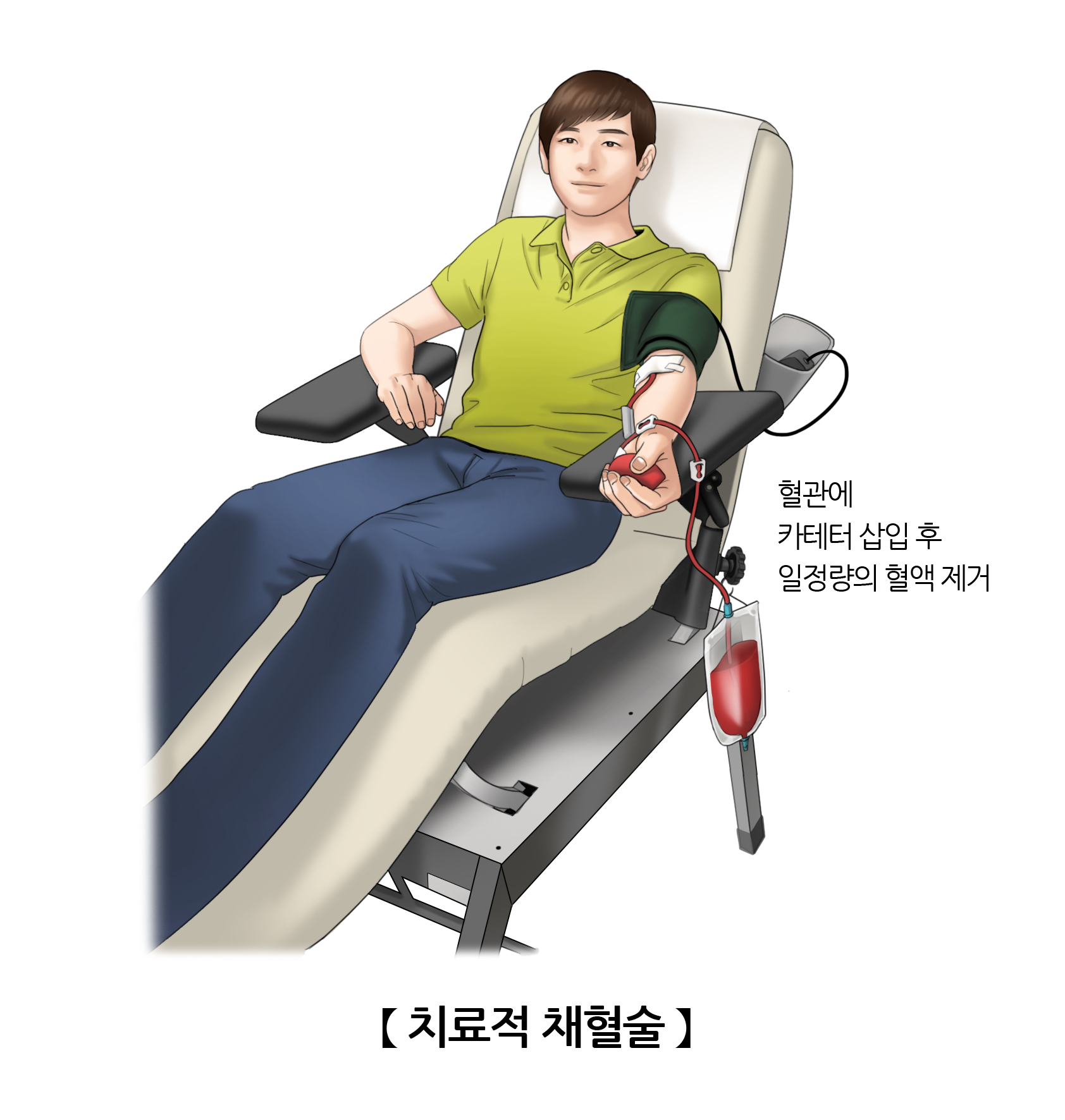 치료적 채혈술