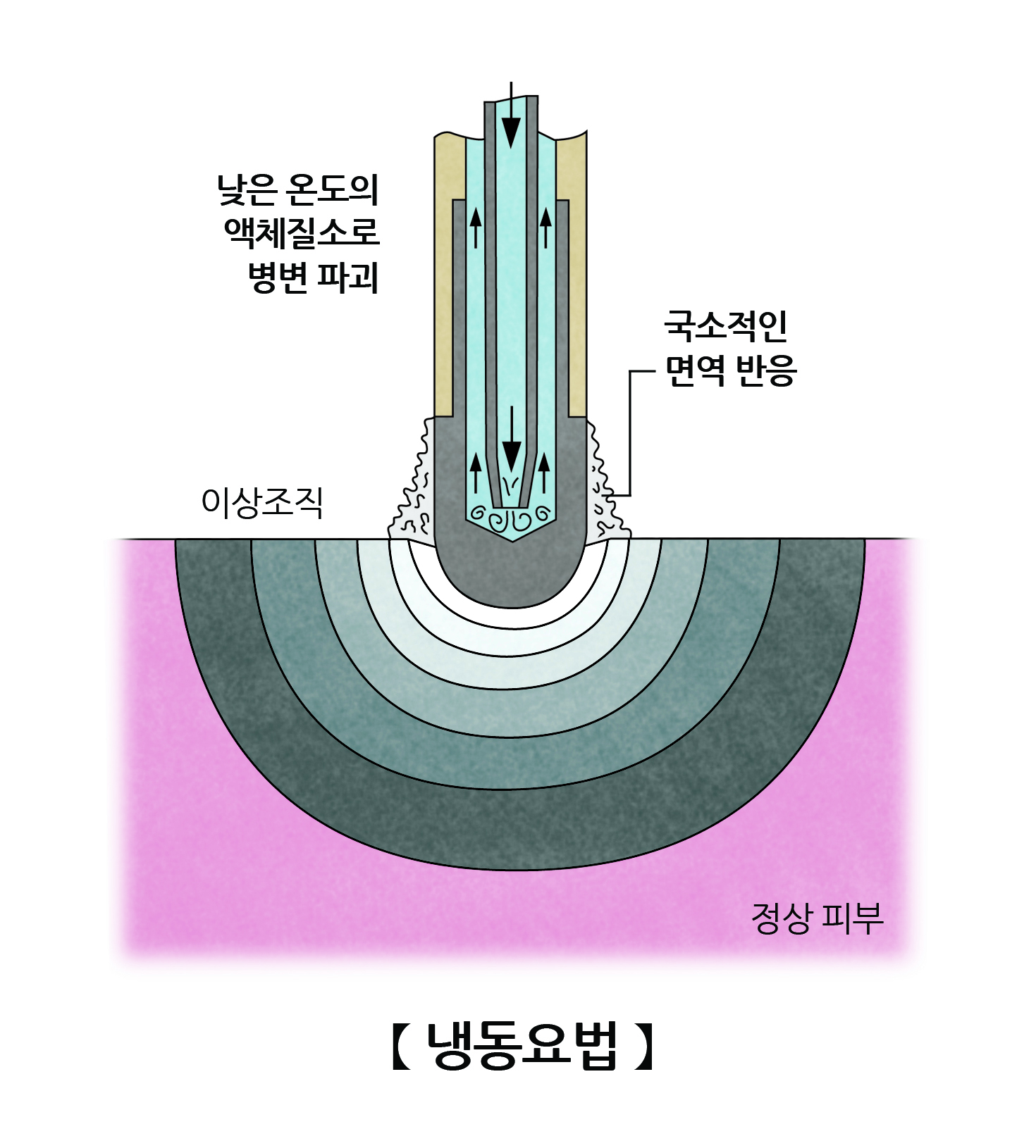 냉동요법