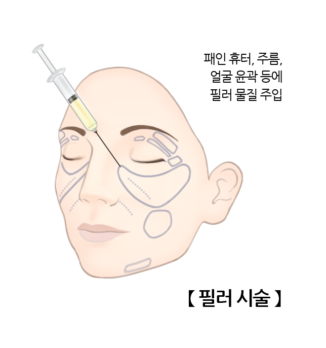 필러시술